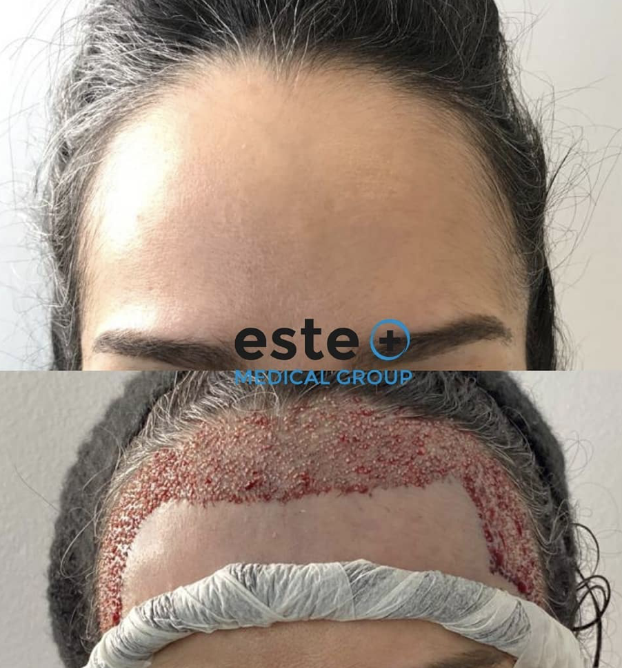 Hair Transplant for Women What You Need to Know Este